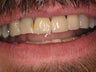 10 Porcelain Veneers