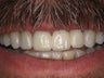10 Porcelain Veneers