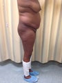 Brazilian Butt Lift