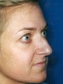 Rhinoplasty