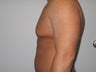 Male Breast Reduction