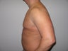 Male Breast Reduction