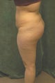 Buttocks Augmentation
