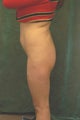 Women's Buttocks Augmentation 