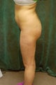 Women's Buttocks Augmentation 