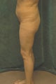 Women's Buttocks Augmentation