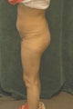 Women's Buttocks Augmentation