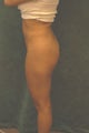 Women's Buttocks Augmentation  