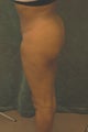 Women's Buttocks Augmentation 