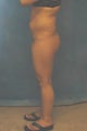 Women's Buttocks Augmentation