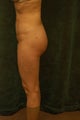 Women's Buttocks Augmentation  