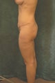 Women's Buttocks Augmentation  