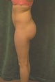 Women's Buttocks Augmentation 