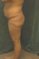 Women's Buttocks Augmentation