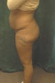Women's Buttocks Augmentation
