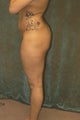 Women's Buttocks Augmentation
