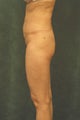 Women's Buttocks Augmentation  