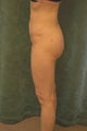 Women's Buttocks Augmentation  