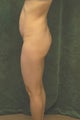 Women's Buttocks Augmentation