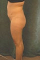Women's Buttocks Augmentation  