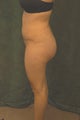 Women's Buttocks Augmentation  