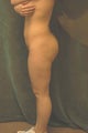 Women's Buttocks Augmentation  