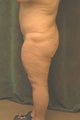 Women's Buttocks Augmentation