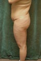 Women's Buttocks Augmentation