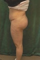 Women's Buttocks Augmentation