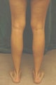 Men's Calf Augmentation  