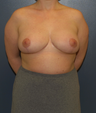 Breast Reduction