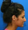 Rhinoplasty