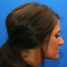 Rhinoplasty