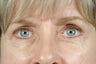 blepharoplasty with ptosis correction (eyelid surgery)