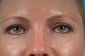 upper blepharoplasty/eyelid surgery