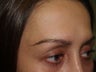 Hair Transplant - Eyebrows