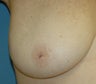 Inverted Nipple Repair