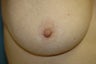 Inverted Nipple Repair