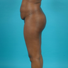 Tummy Tuck