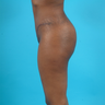 Tummy Tuck