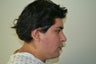 Chin Liposuction