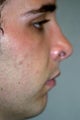 Chin Implant