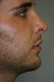 Chin Implant