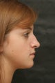 Rhinoplasty