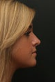 Rhinoplasty