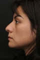 Rhinoplasty