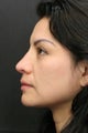Rhinoplasty