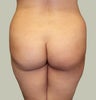 Brazilian Butt Lift with Liposuction