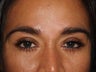 Before, Immediately After, and 1 Year After Eyebrow Transplant Procedure