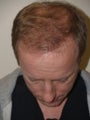 Before, 5 days after, and 10 months after hair transplant procedure